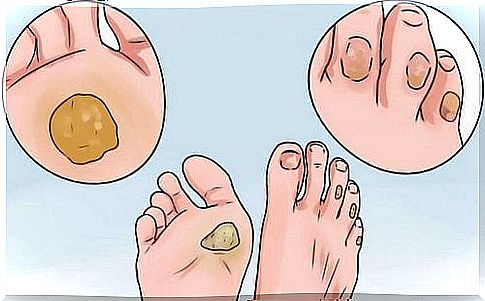 10 Remedies to Say Goodbye to Corns and Blisters