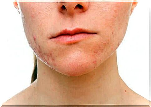 Woman with mild acne