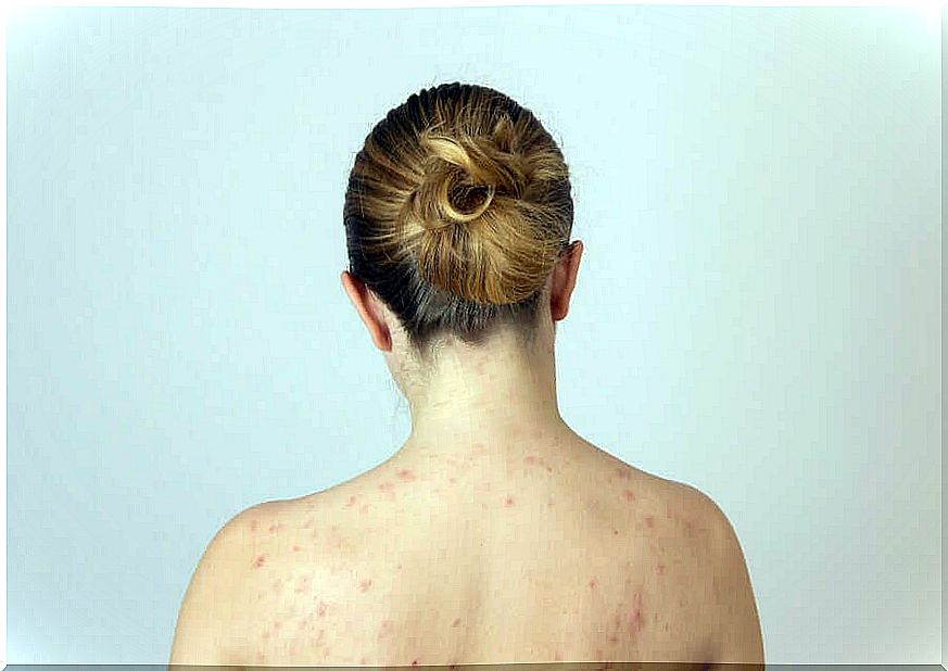 Woman with back acne