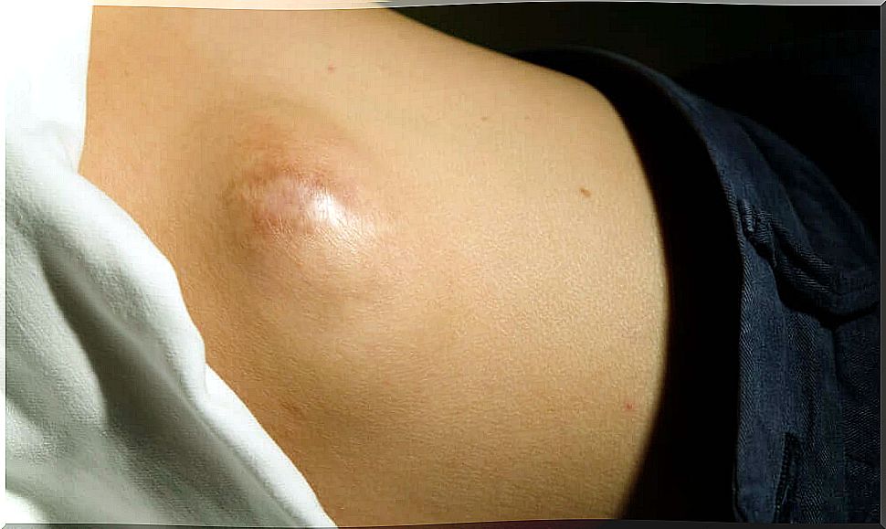 Lipoma in the abdomen