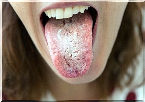 Candidiasis on the tongue