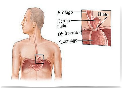 Hiatal Hernia: Natural Remedies for Its Treatment