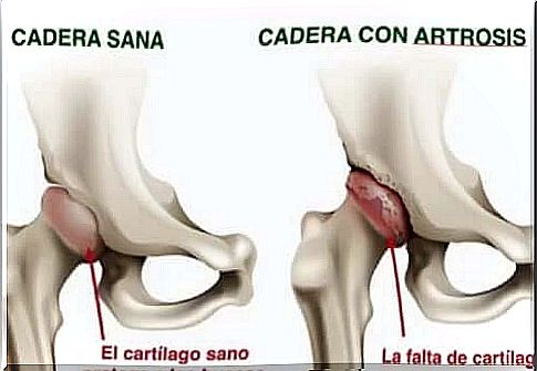 Hip osteoarthritis 