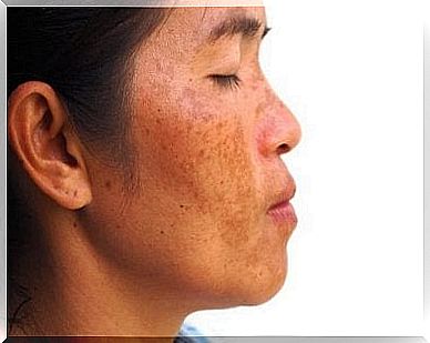 How to make a yogurt, banana and lemon treatment to alleviate melasma