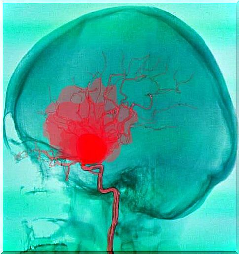 Brain hemorrhage