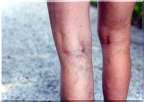 Varicose veins and vascular spiders in the legs