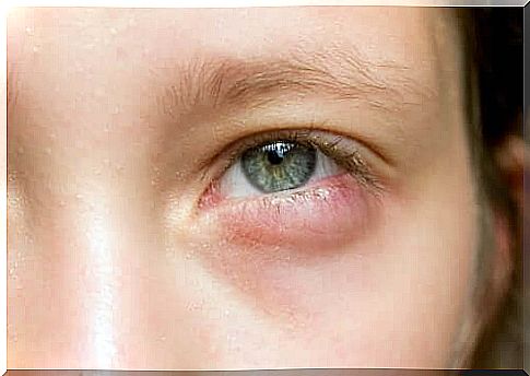 Do you wake up with swollen eyes?  5 quick remedies!